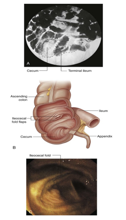 <ul><li><p>Makes up distal 3/5ths of small intestine — mostly in lower right quadrant </p></li><li><p>Thinner walls, fewer/less prominent plicae circulares, shorter vasa recta, more mesenteric fat, and more arterial arcades as compared to jejunum</p></li><li><p>Opens into large intestine, where cecum &amp; ascending colon join together, with the ileocecal fold (2 flaps projecting into large intestine lumen) surrounding the opening — Ileocecal valve</p><ul><li><p>The flaps of the ileocecal fold come together at their end, forming ridges, with musculature from the ileum continues into each flapp — forming a sphincter</p><ul><li><p>Functions to prevent reflex from cecum to ileum (during peristalsis), and regulating passage of contents from ileum to cecum </p></li><li><p>Thought to function passively, as opposed to a defined muscular sphincter</p></li></ul></li></ul></li><li><p>Vascularization —</p><ul><li><p>Arterial —</p><ul><li><p>Ileal arteries from SMA</p></li><li><p>Ileal branch from ileocolic artery, from SMA</p></li></ul></li><li><p>Venous —</p><ul><li><p>SMV formed by small terminal veins small terminal veins that drain the ileum, cecum, &amp; vermiform appendix </p><ul><li><p>SMV runs superomedially, traversing mesentery of small intestine</p></li></ul></li></ul></li></ul></li></ul>