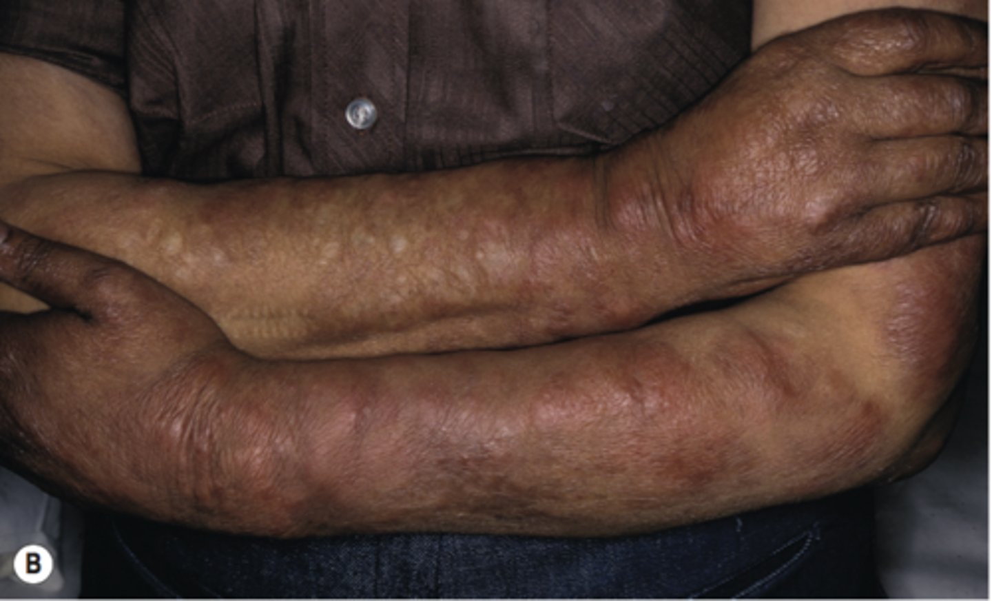 <p>leprosy</p>