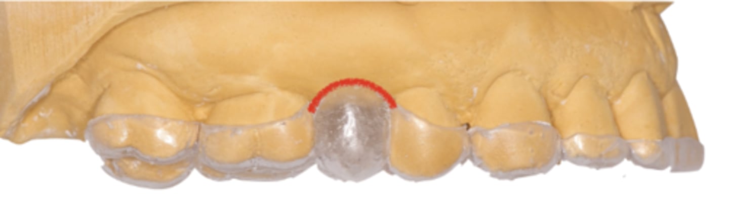 <p>Which of the following best describes the image shown? (Select one)</p><p>a. Restricted analog surgical guide</p><p>b. Non-restricted analog surgical guide</p><p>c. d-CAIS (dynamic computer assisted implant surgical guide)</p><p>d. s-CAIS (static computer assisted implant surgical guide)</p>
