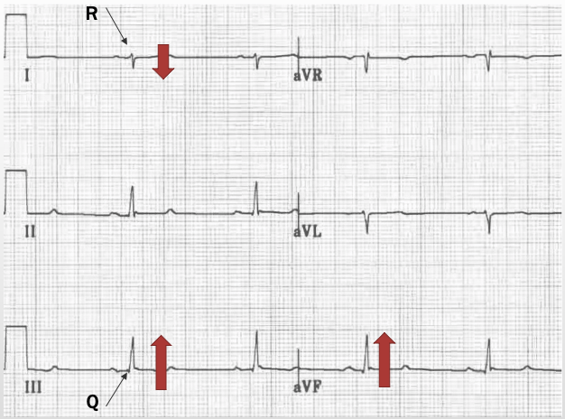 <p>RAD, R wave in lead I and Q wave in lead III, mostly + lead III</p>