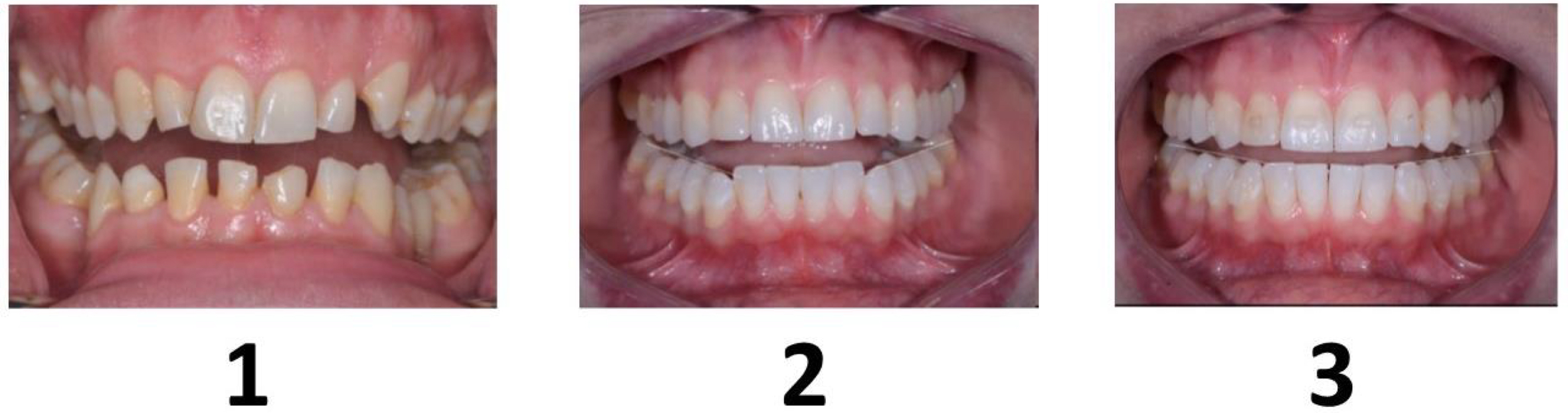 <p>In which case is the occlusal plane appropriate? <strong>exam q</strong></p>