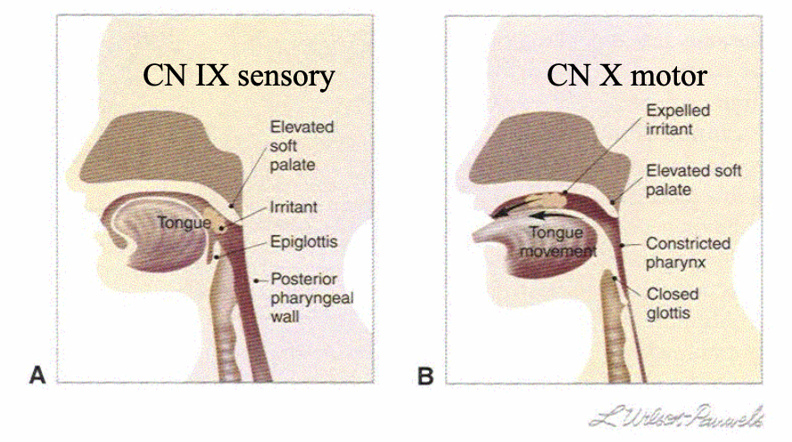 <p><strong>Sensory input → Glossopharyngeal nerve → Medulla → Motor output via Vagus nerve → Gag response</strong></p><ul><li><p><strong>Stimulus:</strong> The gag reflex is triggered when something touches the back of the throat, soft palate, or the back of the tongue.</p></li><li><p><strong>Afferent Pathway</strong>: Sensory receptors in the throat (e.g., pharyngeal and palatal areas) send signals to the <strong>glossopharyngeal nerve (CN IX)</strong>.</p></li><li><p><strong>CNS Processing</strong>: The signal is relayed to the <strong>medulla oblongata</strong> (brainstem), which processes the sensory input.</p></li><li><p><strong>Efferent Pathway</strong>: The motor response is carried via the <strong>vagus nerve (CN X)</strong> to the muscles of the soft palate, pharynx, and larynx, causing contraction and the reflexive gagging response.</p></li><li><p><strong>Action</strong>: This causes a rapid contraction of the muscles, leading to a gagging sensation, which helps expel or prevent the object from entering the airway.</p></li></ul><p></p>