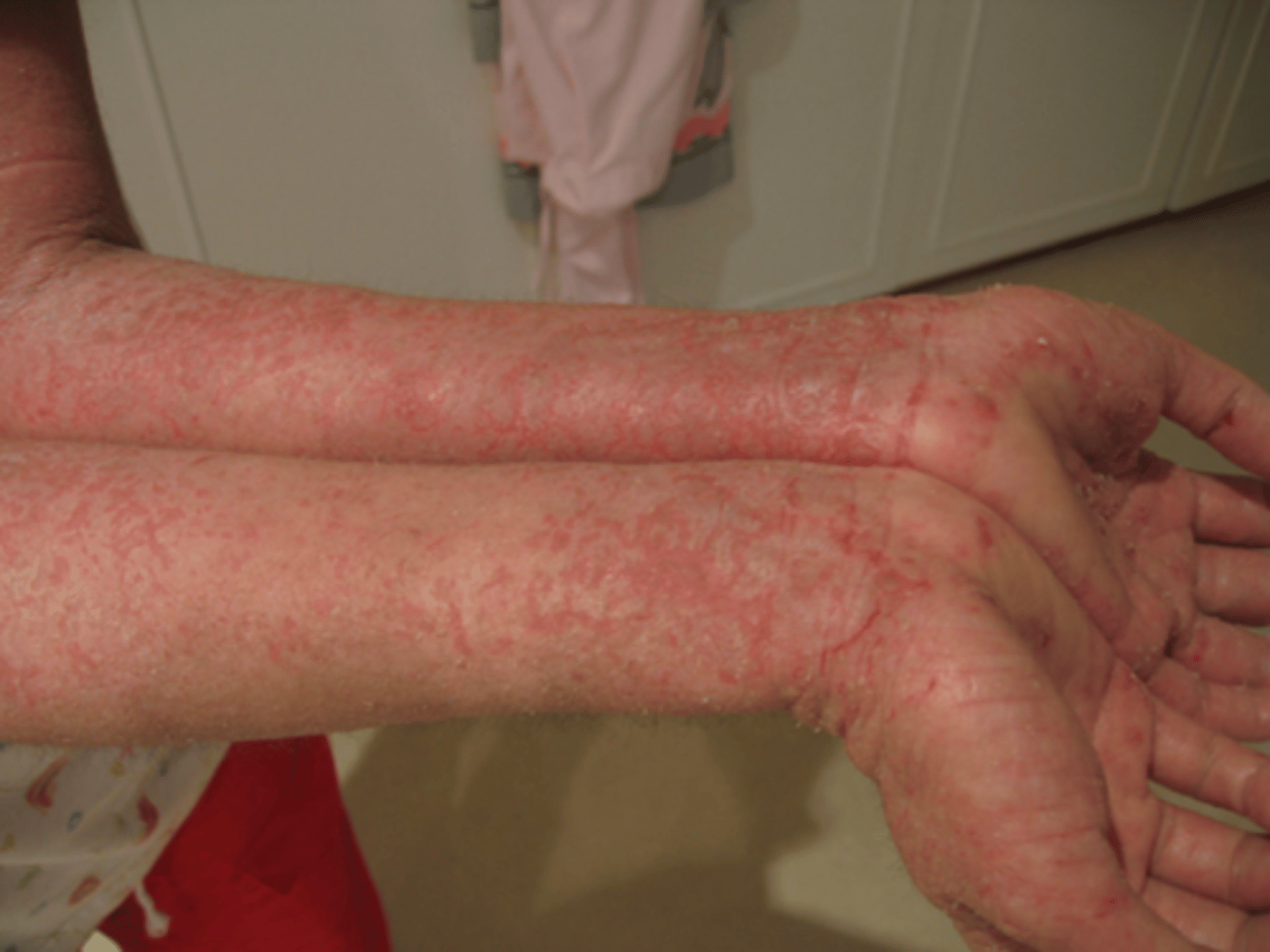 <p>A common skin disorder that presents as a red, flaky rash.</p>