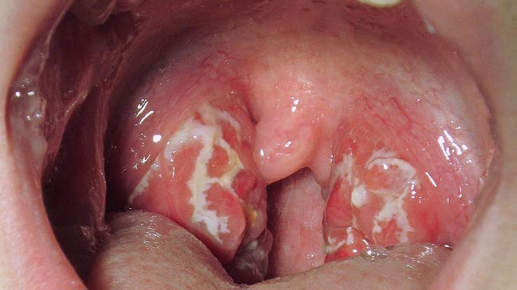 <p><span>A patient is presenting at the GP with a sore throat, temperature of 38.2°C, 48 hours since onset of pain, and no cough. What could be the possible diagnosis or considerations?</span></p><p><span><mark data-color="green">Lecture Slide 16</mark></span></p>