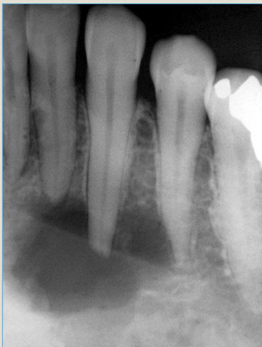 <p>Well defined lucency with no cortication</p>