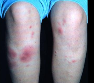 <p>A type of sarcoidosis that is scattered, nonspecific, tender, red nodules on lower legs</p>
