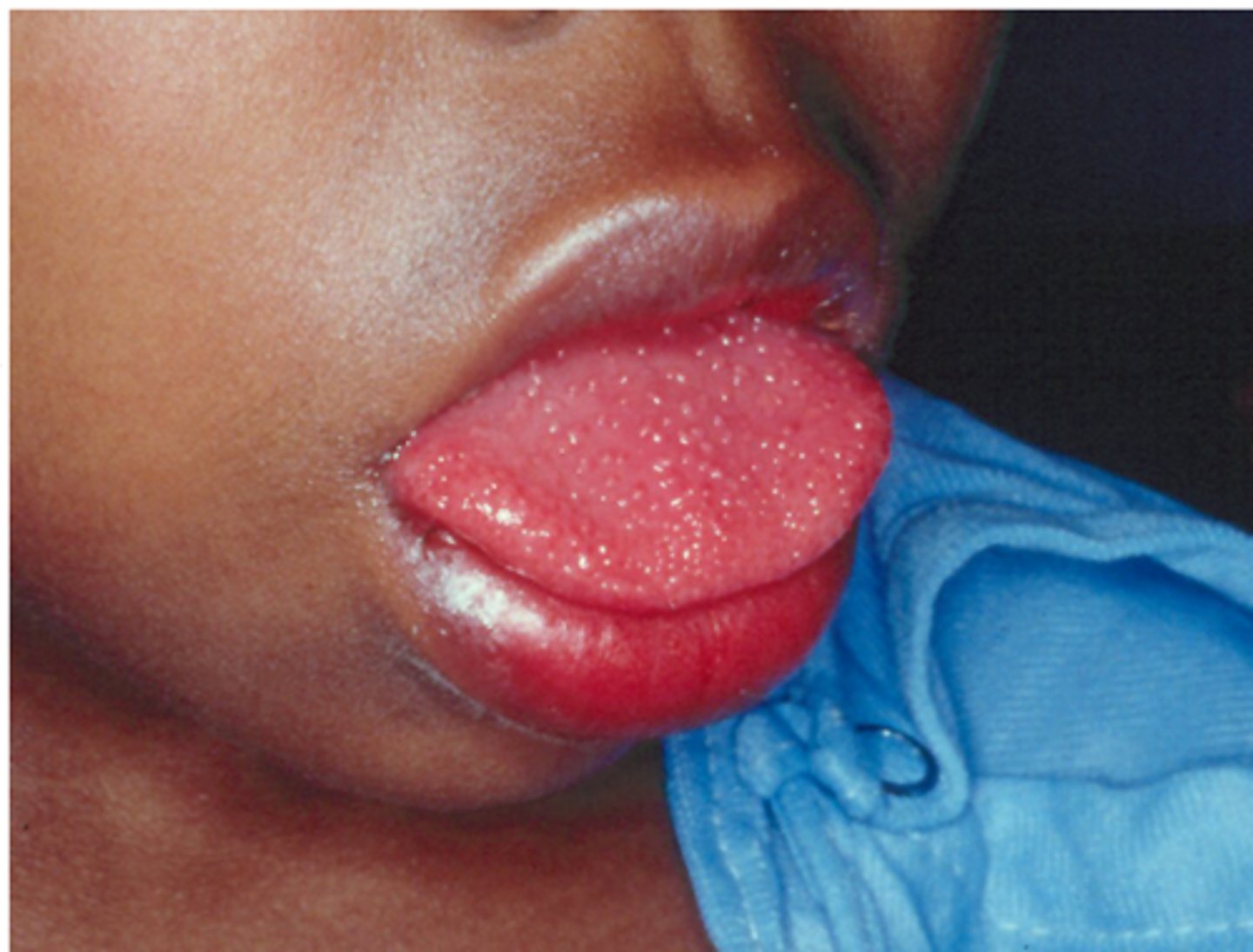 <p>inflammation of the tongue</p>