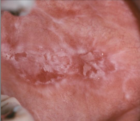 <p>What does contact mucositis clinically look similar to </p>