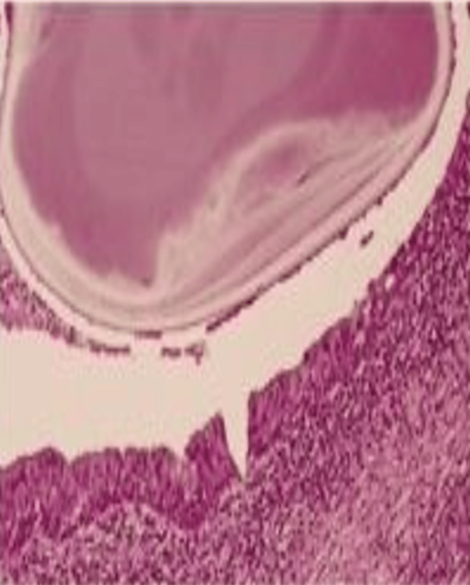 <p>Calcified mass, Surrounded by inflamed and fibrotic salivary glands</p>