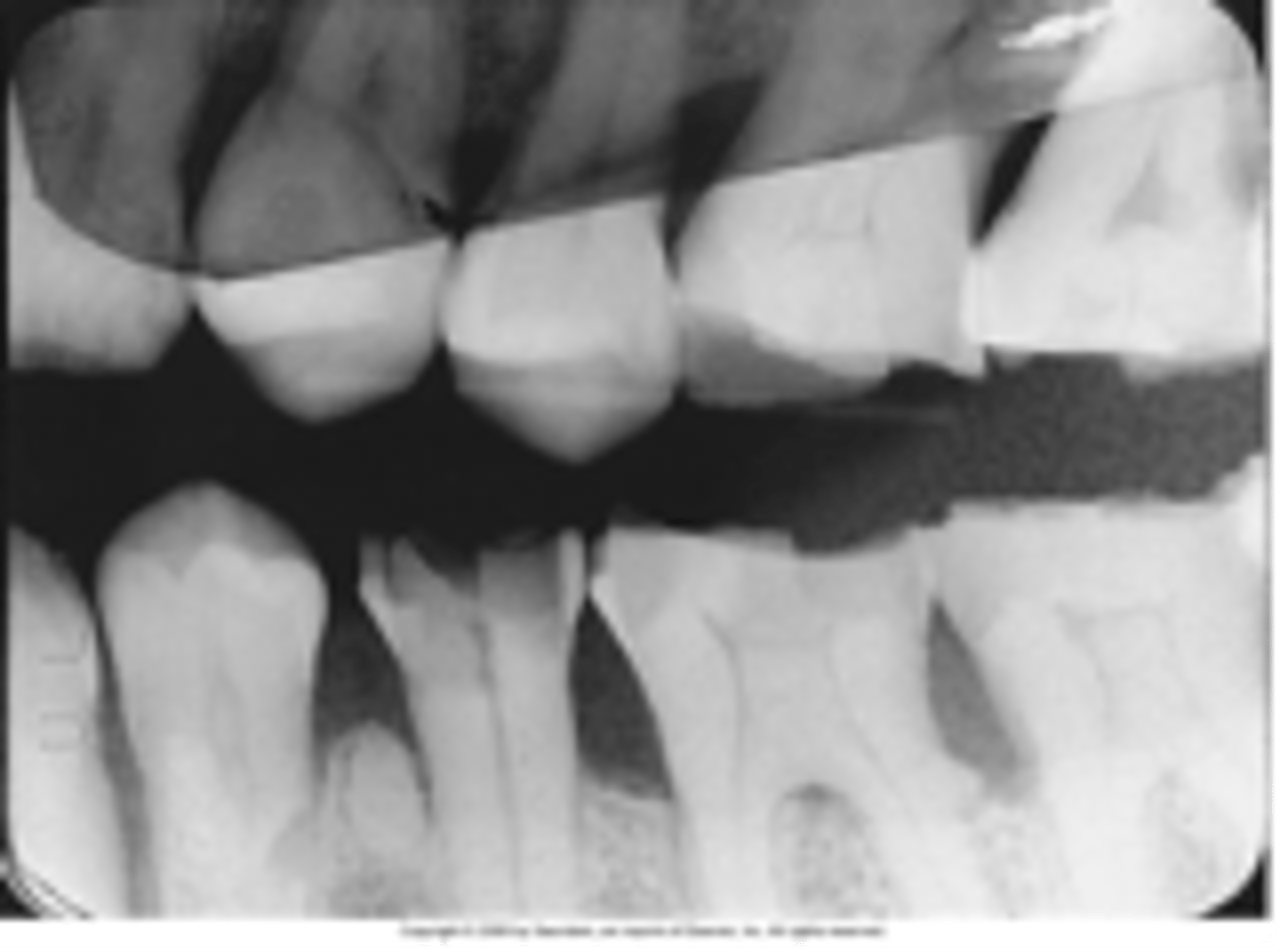 <p>White or dark areas appear on film where overlapped due to:</p><p>•Two films contacting each other during processing</p>