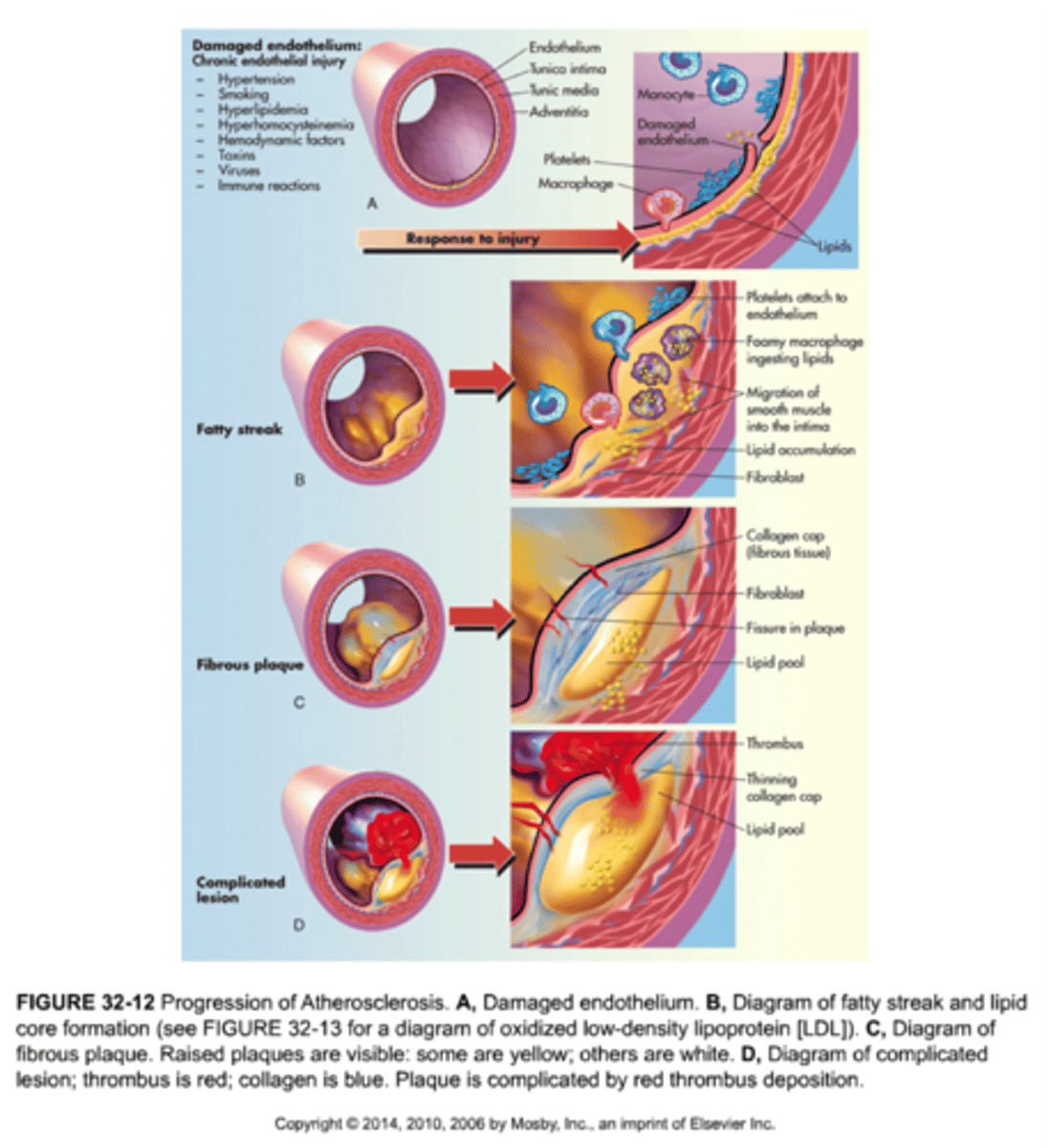 <p>1) Endothelial cell dysfunction</p><p>2) Macrophage and LDL accumulation</p><p>3) Foam cell formation</p><p>4) Fatty streaks</p><p>5) Smooth muscle cell migration proliferation and extracellular matrix deposition</p><p>6) Fibrous plaque</p><p>7) Complex atheromas</p><p>8) Calcification (Risk of complications)</p>