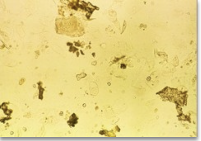 <ul><li><p class="">Source:<br>• Improper collection (especially in infants)<br>• Entero-urinary fistulas</p></li><li><p class="">Microscopy:<br>• Irregular debris resembling <strong>plant material</strong>, <strong>meat fibers</strong>, or other gut contents</p></li><li><p class="">Interpretation tip:<br>• Consider <strong>patient age</strong> and <strong>clinical history</strong></p></li></ul><p></p>
