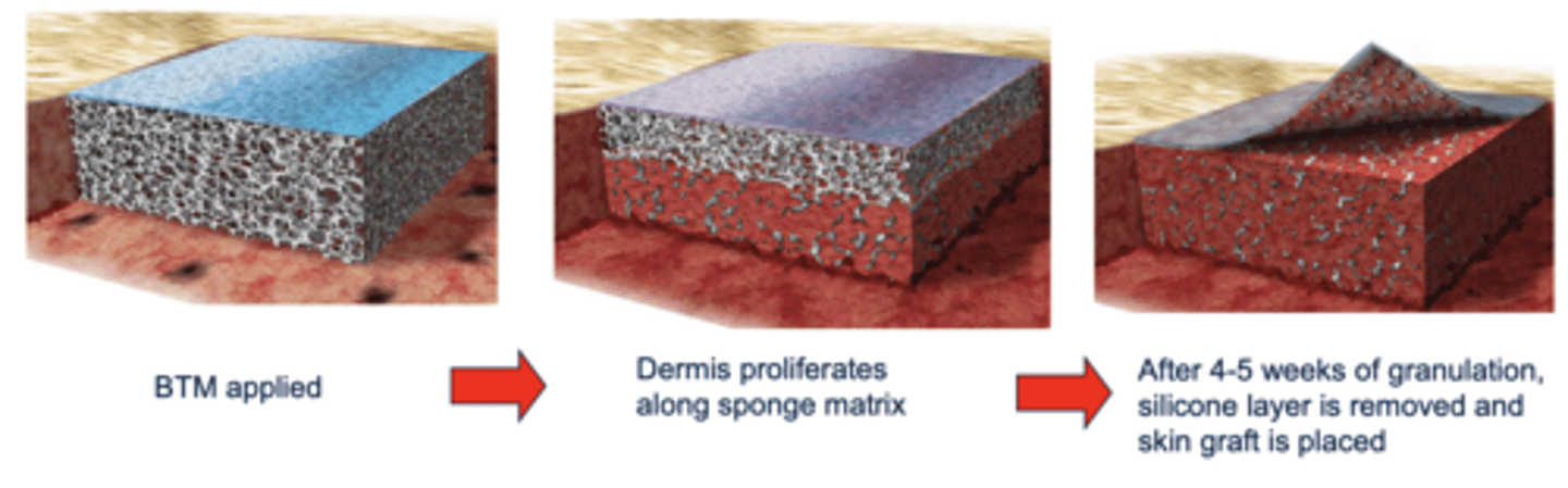 <p>1. 2 layer system: dermal replacement (synthetic sponge) and epidermal replacement (silicone)</p><p>2. wound debrided to viable tissue and BTM layered on top for 4-5 weeks (allow granulation to occur)</p><p>3. dermis proliferates along sponge matrix</p>