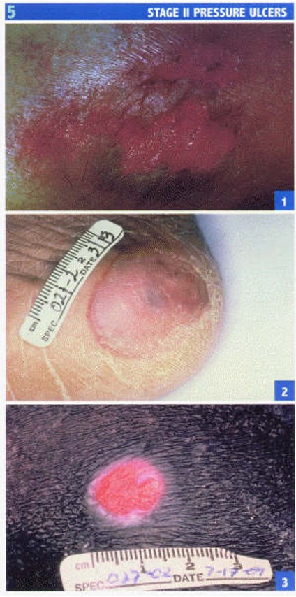 <p>partial thickness skin loss involving epidermis and/or dermis</p>