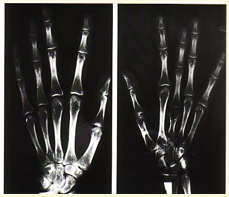 <p><span><span>Fingertips lost due to infarction</span></span></p>