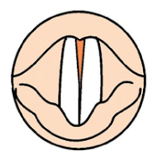 What type of VF closure is this?