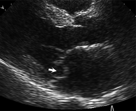 <p>What can be evaluated regarding the Mitral Valve in PSLA?</p>