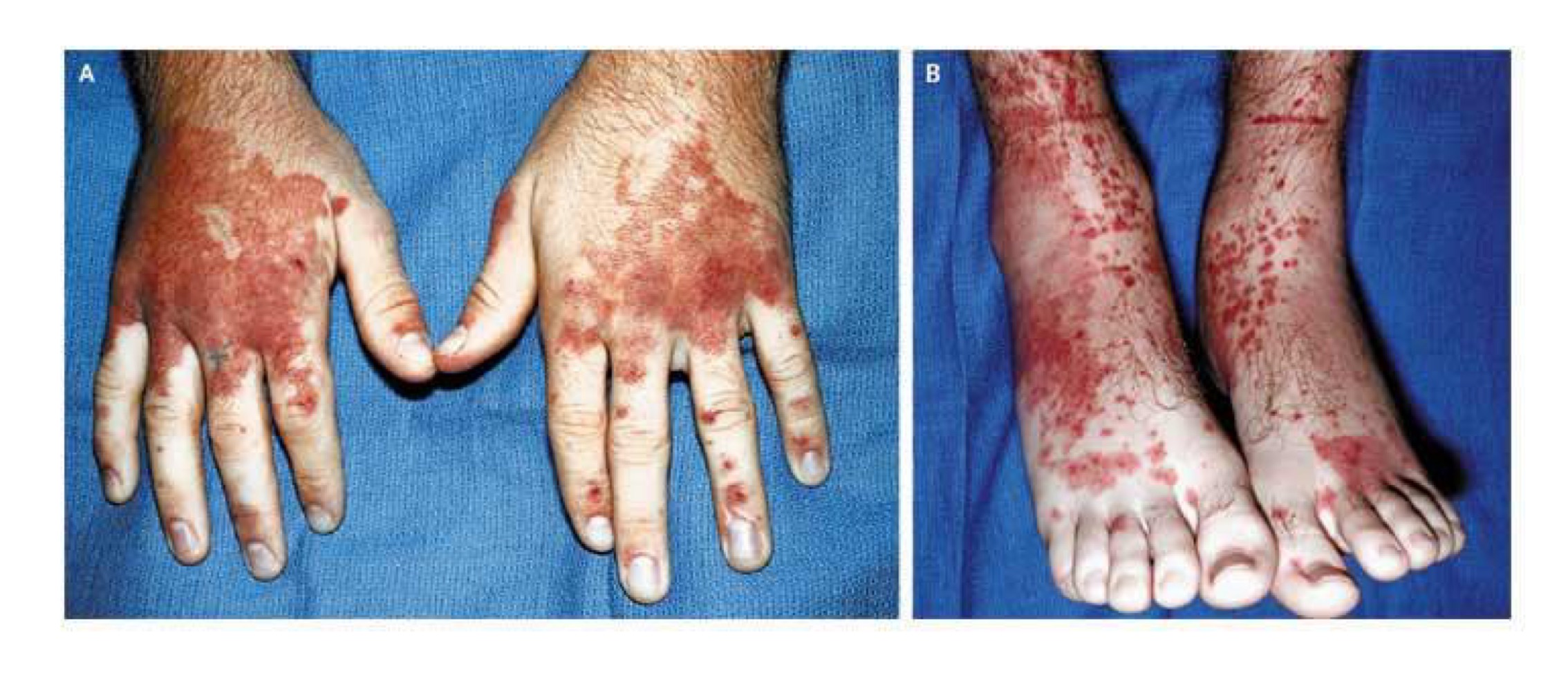 <p>what type of skin lesion is this? </p>