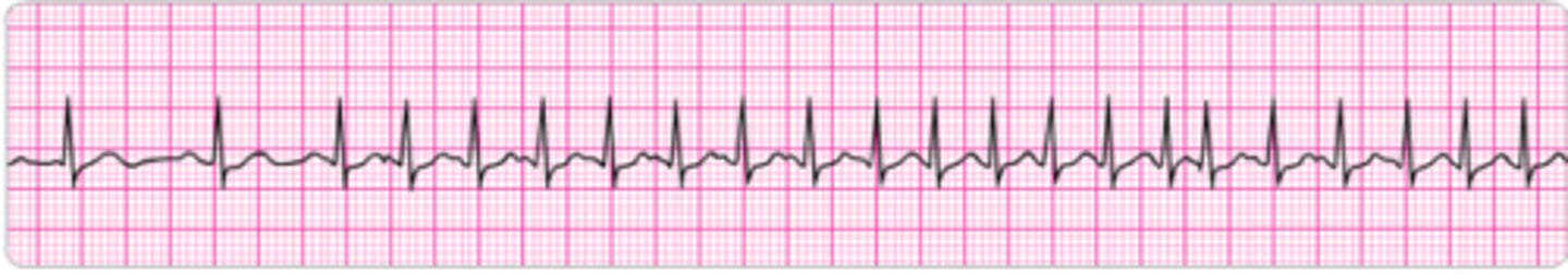 <p>Identify the rhythm.</p>