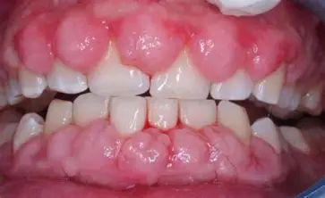 <ol><li><p>take @ <span style="color: rgb(10, 169, 188);"><strong>same time daily</strong></span></p></li><li><p>causes <span style="color: rgb(20, 165, 16);"><strong>gum overgrowth → good oral care</strong></span></p></li><li><p>no oral <span style="color: rgb(202, 112, 17);"><strong>contraceptives</strong></span> (reduced effectiveness)</p></li><li><p><span style="color: rgb(233, 55, 55);"><strong><u>no WARFARIN!!!!!</u></strong></span></p></li><li><p>need <span style="color: rgb(99, 87, 235);"><strong>blood level monitoring</strong></span>&nbsp;</p></li></ol><p></p>