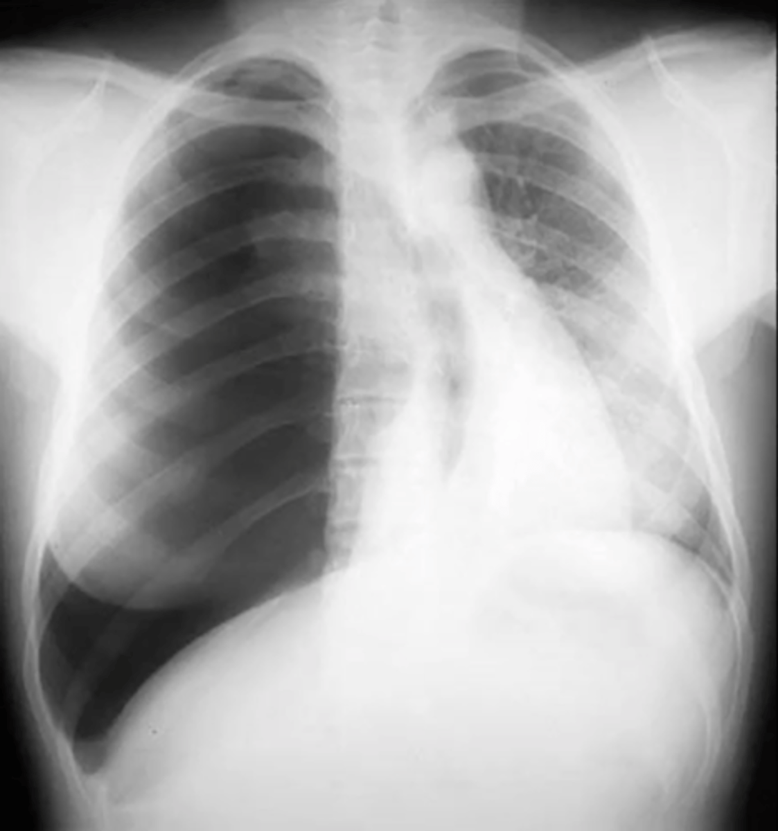 <p>(CXR examples) right lung shows only air; tracheal deviation to the left</p>