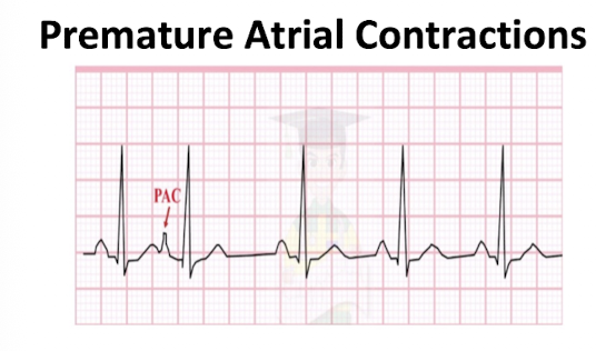 <p>Premature Atrial Contraction:</p><p>NOTICE:</p><ul><li><p>Look for: </p><ul><li><p>Little bump AFTER T wave</p></li><li><p>P wave comes EARLY </p></li><li><p>QRS Normal </p></li></ul></li><li><p>NO 911/NOT EMERGENCY </p><ul><li><p>MONITOR AND CONTINUE AT LOWER INTENSITY </p></li></ul></li></ul><p></p><p></p><p>FLIP</p><p></p>