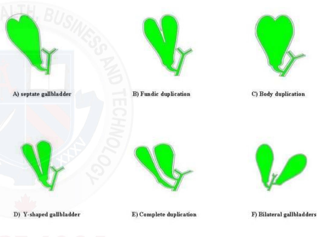 <p>Full septations/2 gallbladders </p><p>Very rare </p><p>Can’t confirm by ultrasound </p>