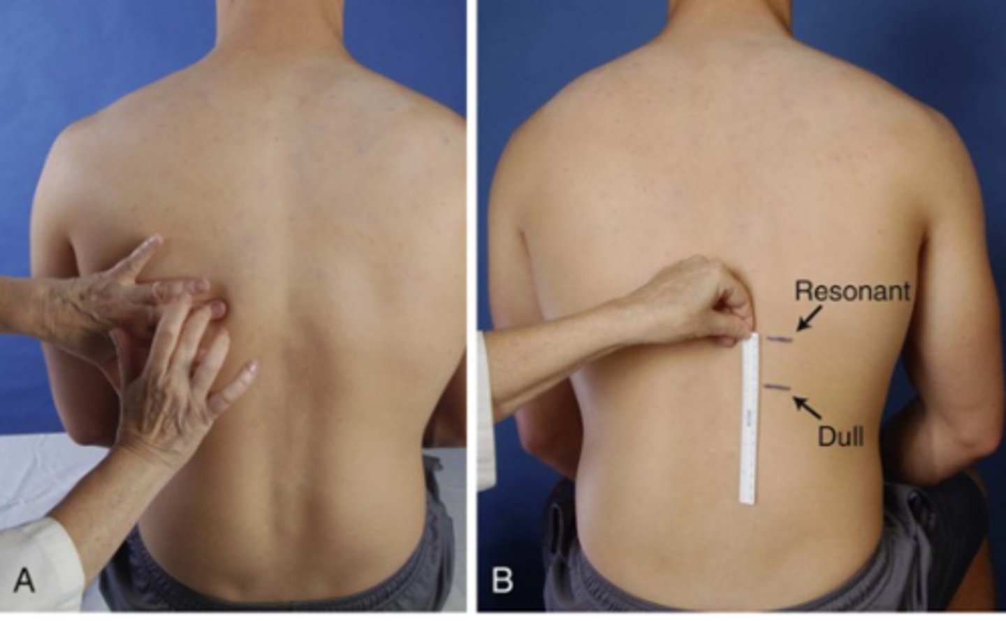 <p>1. ask patient to exhale and percuss down to dullness<br>2. ask patient to inhale and percuss down to dullness again<br>3. measure the distance between the 2 lines<br><br>*difference should be equal b/l (3 - 5 cm)<br>*not used in clinical practice very much anymore</p>