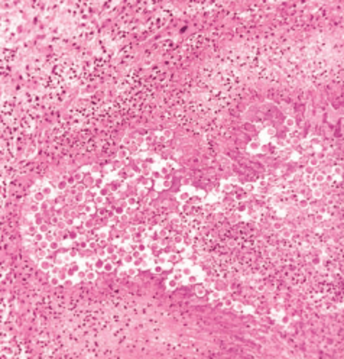 <p>A 30-year-old man from Mexico presents with a 3-week history of constant pain in his upper right quadrant and epigastrium and persistent cough. The patient also reports a recent history of nausea, vomiting, and bloody diarrhea. Physical examination shows hepatomegaly and tenderness over the right upper quadrant. A liver biopsy displays ﬁbroblastic proliferation and trophozoites (shown in the image). Which of the following is the most likely diagnosis?</p><p>(A) Amebic liver abscess</p><p>(B) Cystic hydatid disease</p><p>(C) Hepatic malaria</p><p>(D) Pyogenic liver abscess</p><p>(E) Weil disease</p>
