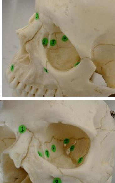 <p>#4 - (orbit and facial sutures)</p>