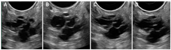 <ul><li><p><span style="background-color: transparent;">Mucinous cystic neoplasm</span></p></li><li><p><span style="background-color: transparent;">Originates from main pancreatic duct or its branches</span></p></li><li><p><span style="background-color: transparent;">Slow-growing, affects men and women, tends to occur in 60s and 70s </span></p></li><li><p><span style="background-color: transparent;">Can be benign or malignant</span></p></li></ul><p></p>