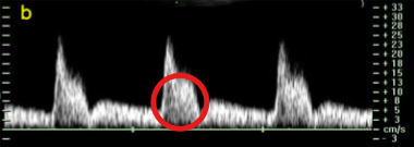 <p>What is the name of this circled finding on the spectral waveform? </p>