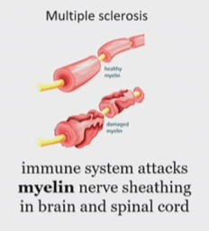 <p>Neuropathic pain </p>
