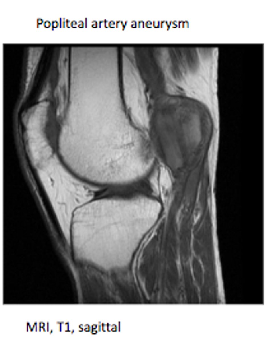 <p>A: Loss of distal pulses and cold lower leg</p>