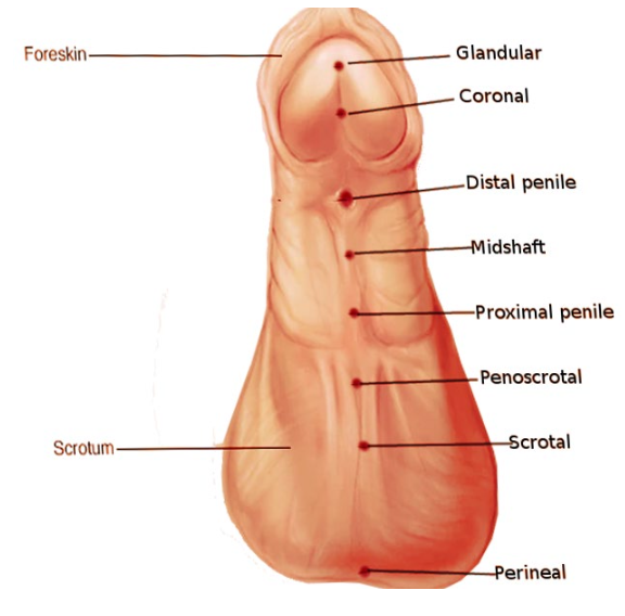 <ul><li><p>Congenital abnormality in which the <strong>urinary meatus is located on the <u>ventral</u> surface of the penis</strong></p></li><li><p class="p1">Incidence: 1/300 male infants</p></li></ul><p></p>