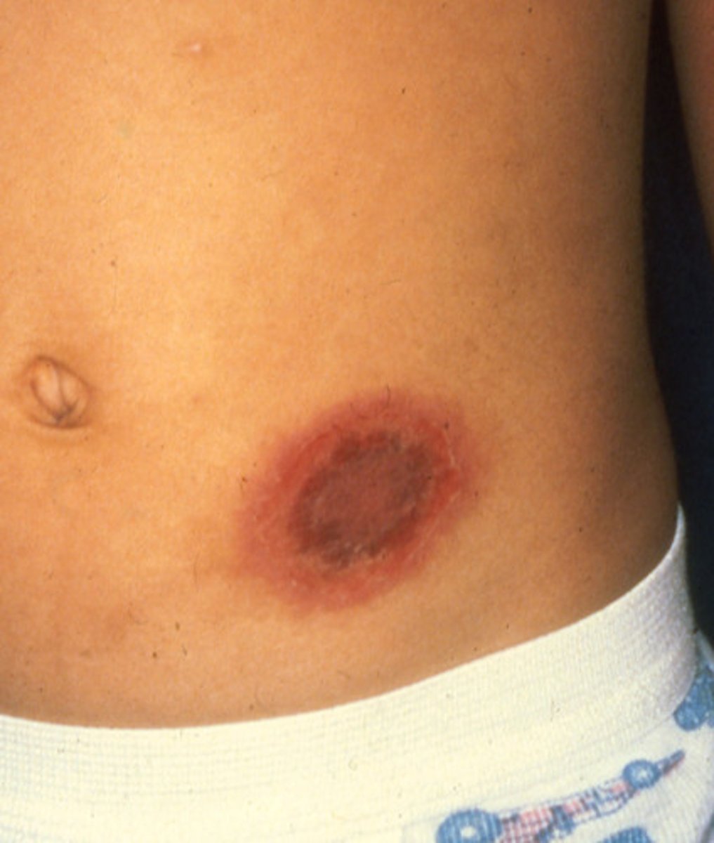 <p>This is a type of adverse drug reaction characterized by the formation of a SOLITARY erythematous patch or plaque that will recur at the same site with re-exposure to the drug.</p>