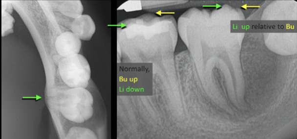 <p>Describe the radiographic features of this Buccal Bifurcation Cyst?</p>