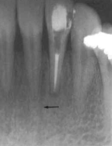<p><span>contain blood vessels supplying the bone and occur in both mandible and maxilla</span></p><p><span>lies between the </span><span style="color: red;"><span>central and lateral incisors as a vertical radiolucent line</span></span></p>