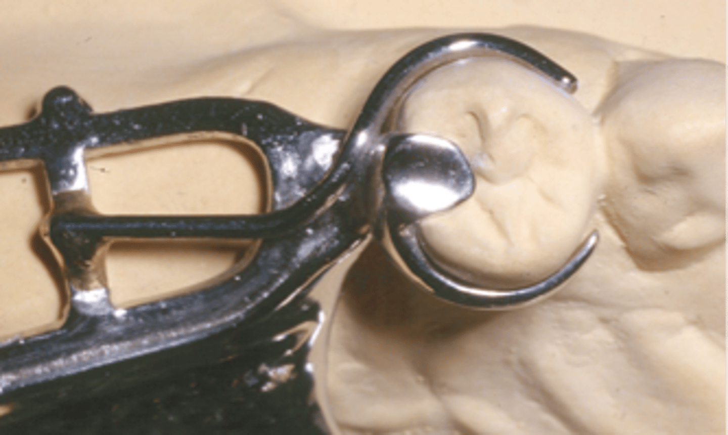 <p>Suprabulge type clasp with a combination of two different metals (via soldering).</p><p>Stress-releasing clasp assembly (due to material), used on extension base RPD’s.</p>