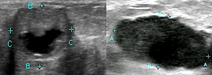 <p>associated with hepatic candidiasis </p><ul><li><p>appears with a peripheral hypoechoic zone, an inner echogenic wheel, and a hypoechoic center</p></li></ul>