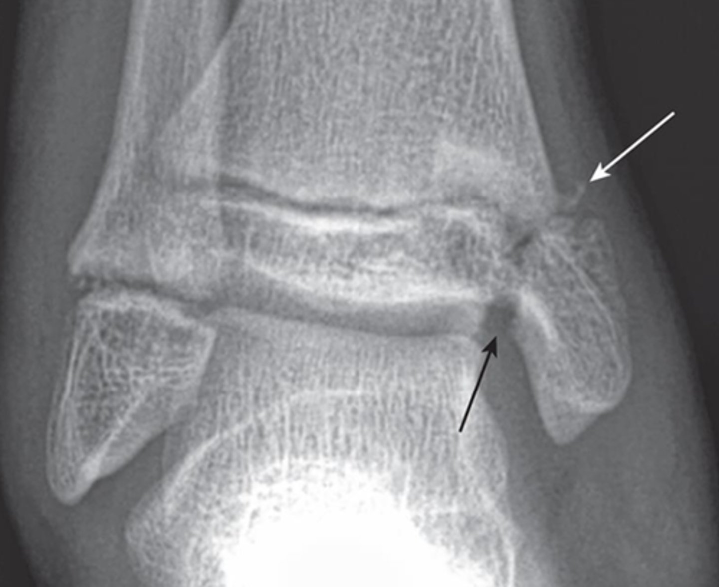 <p>What type of fracture is this?</p>