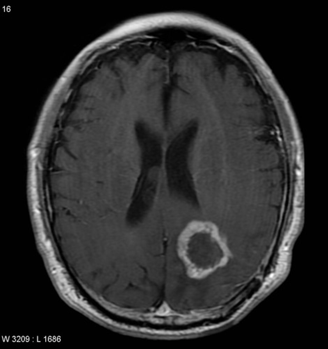 <p>Grade IV astrocytoma (aka it's a subtype of an astrocytoma); they are the most common malignant primary brain tumor (are super aggressive &amp; infiltrative - very deadly)</p>
