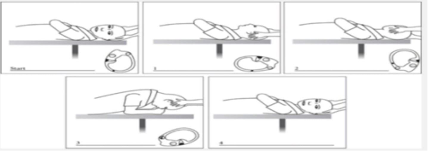 <p>B. Horizontal semicircular Canal BPPV in left Ear</p><p>start with L side and BBQ technique for horizontal SCC start in supine position</p>
