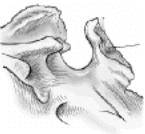 <p><strong>The part of the sphenoid bone identified by the line pointing to it in the figure below is the:</strong><br>A. Sella Turcica<br>B. Clinoid processes<br>C. Dorsum Sellae<br>D. Clivus</p>