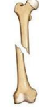 <p>what kind of fracture is this </p>
