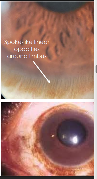 <ol><li><p>• Diffuse distribution of lymph with <strong><u>chemosis </u></strong></p></li><li><p>• Localized appearance, <strong><u>"string of pearls” </u></strong></p></li><li><p><strong><u>• Bleeding into lymph channels cause hemorrhagic lymphangiectasia</u></strong></p></li></ol><p></p>