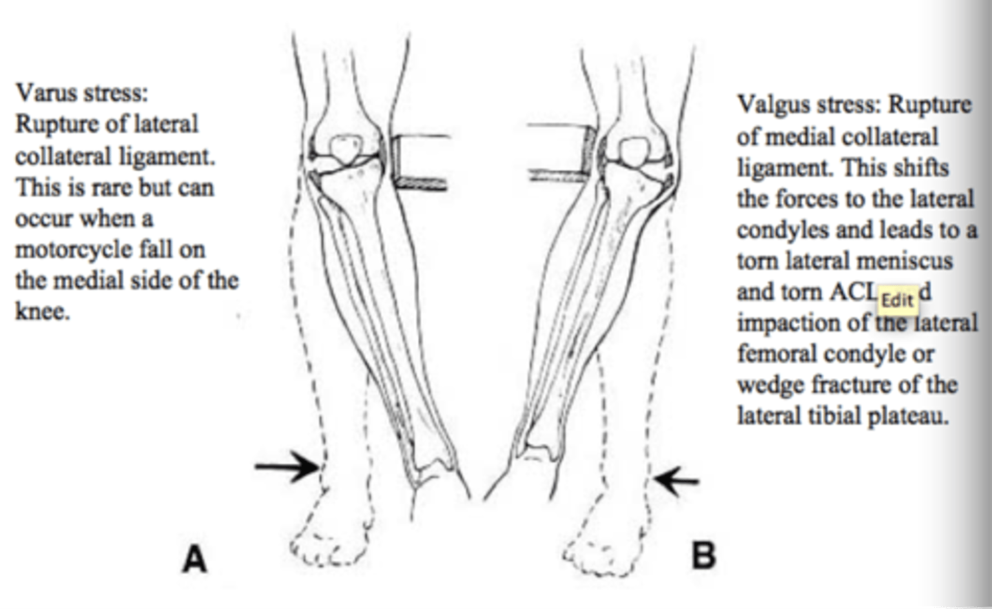 <p>What does it test for?</p><p>- tear of the MCL</p><p>How do you perform it?</p><p>- knee extended or at 30 degree, apply force laterally (VALGUS/external rotation) while stabilizing knee</p><p>- if there is medial space widening --> MCL injury</p>