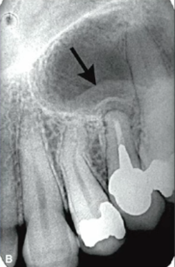 <p>what is this lesion </p>
