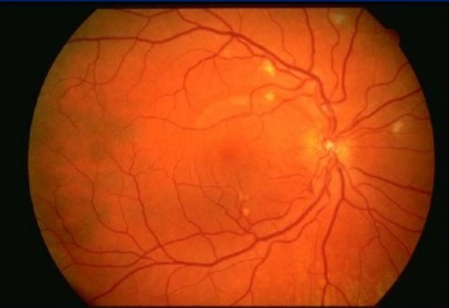 <p>Which type of retinopathy is this?</p>