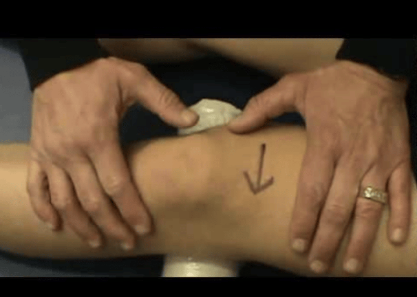 <p>- past history of patella dysfunction</p><p>(+): pt doesn't allow the patella to move in lateral direction</p>